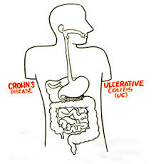  dessin illustrant la maladie de Crohn et la colite ulcéreuse et comment ils affectent le système digestif interne