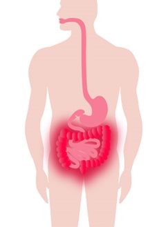 Système digestif montrant une inflammation chez une personne atteinte de colite ulcéreuse